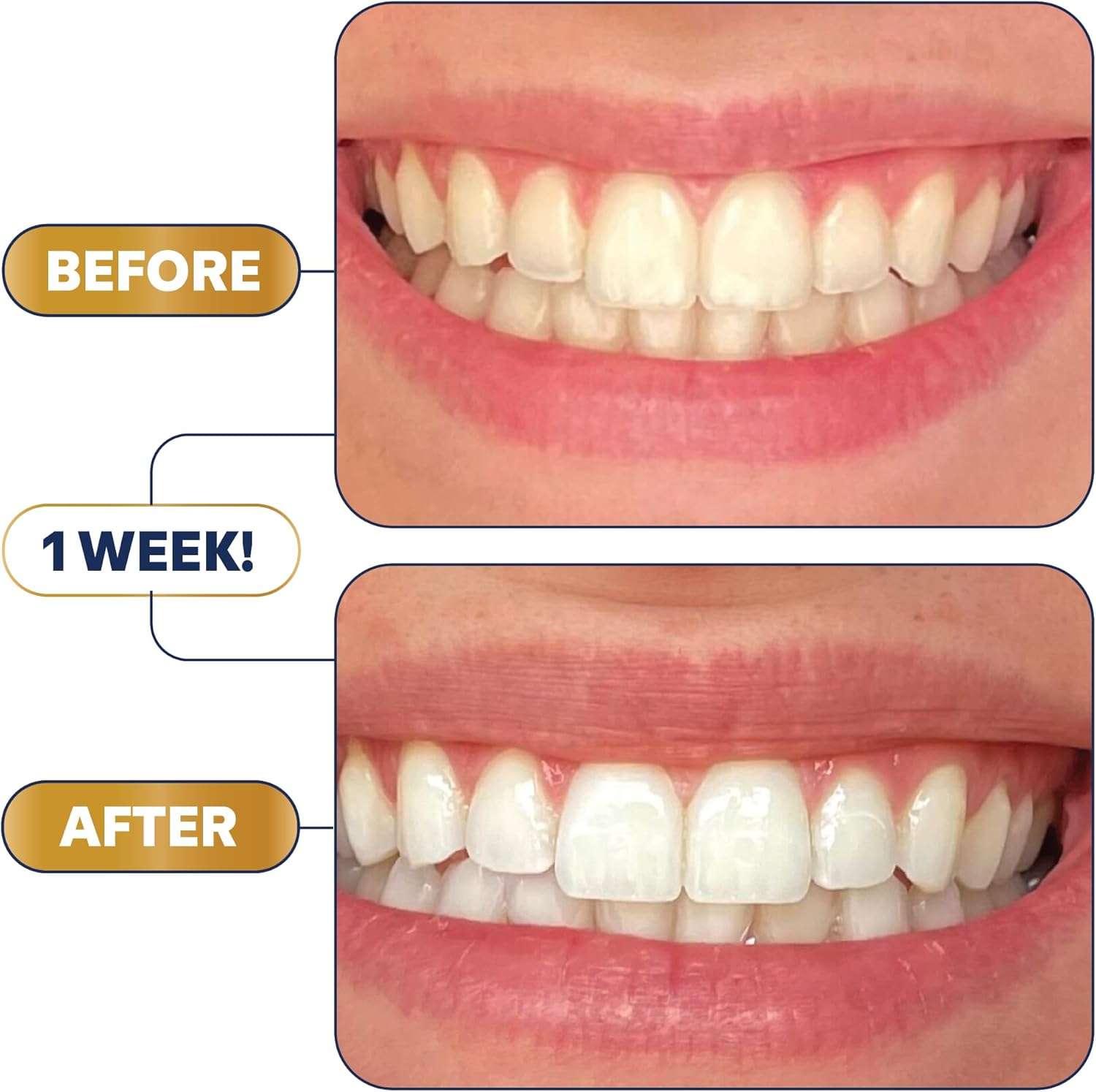 Lumineux Teeth Whitening Strips – 21 Treatments, Peroxide-Free, Enamel Safe, Sensitivity-Free